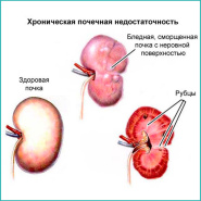 Пептиды восстанавливают функциональное состояние почек при цисплатиновой острой почечной недостаточности